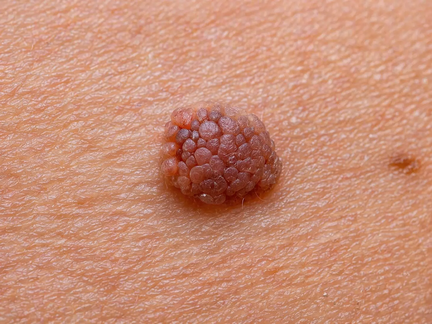 Procedimiento de LEEP cervical y conización realizado por la Dra. Sofía Torres para tratamiento de lesiones cervicales y control ginecológico.