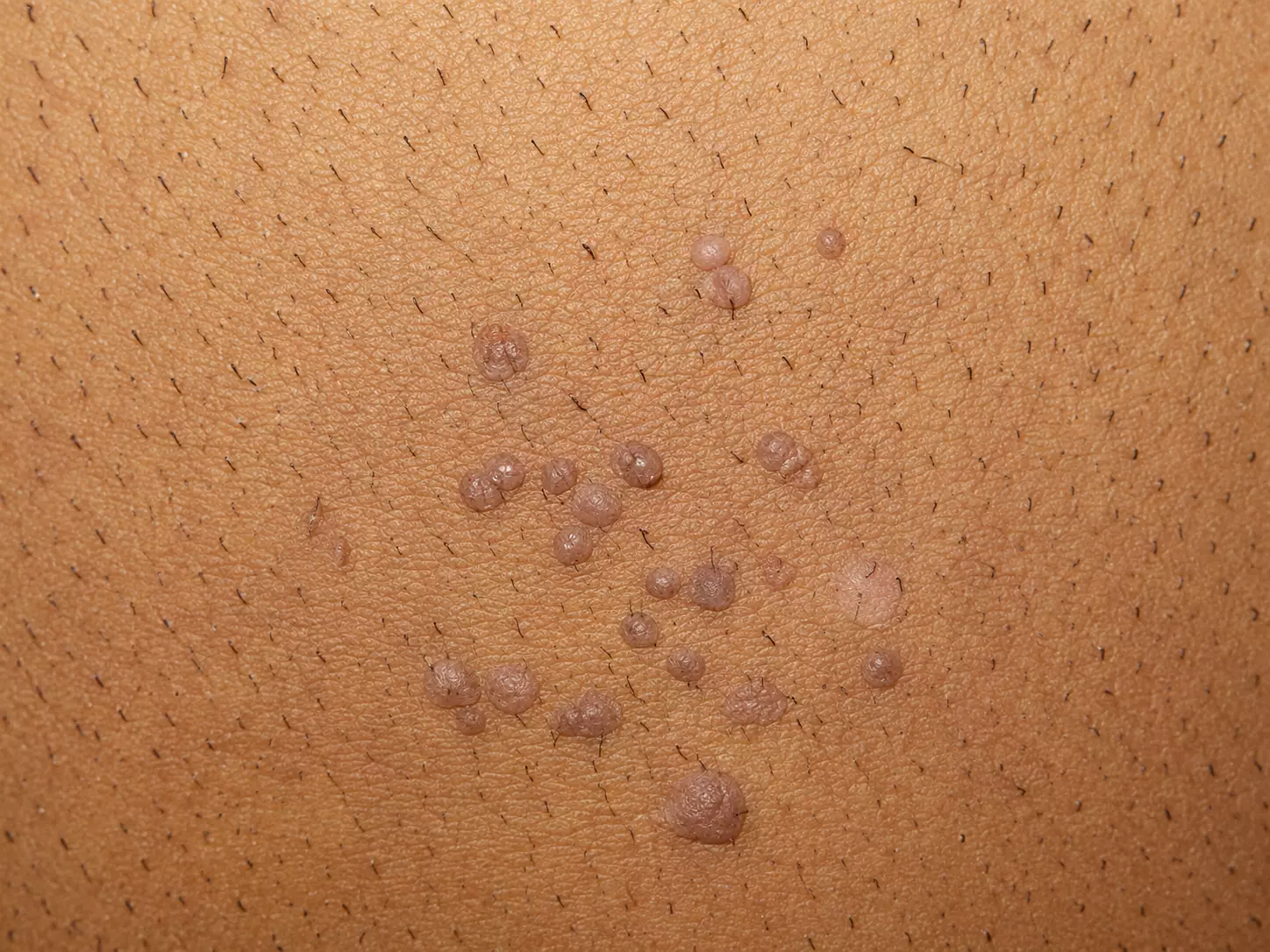 Tratamiento integral de HPV con la Dra. Sofía Torres especialista en prevención, diagnóstico y salud ginecológica en Córdoba Capital.