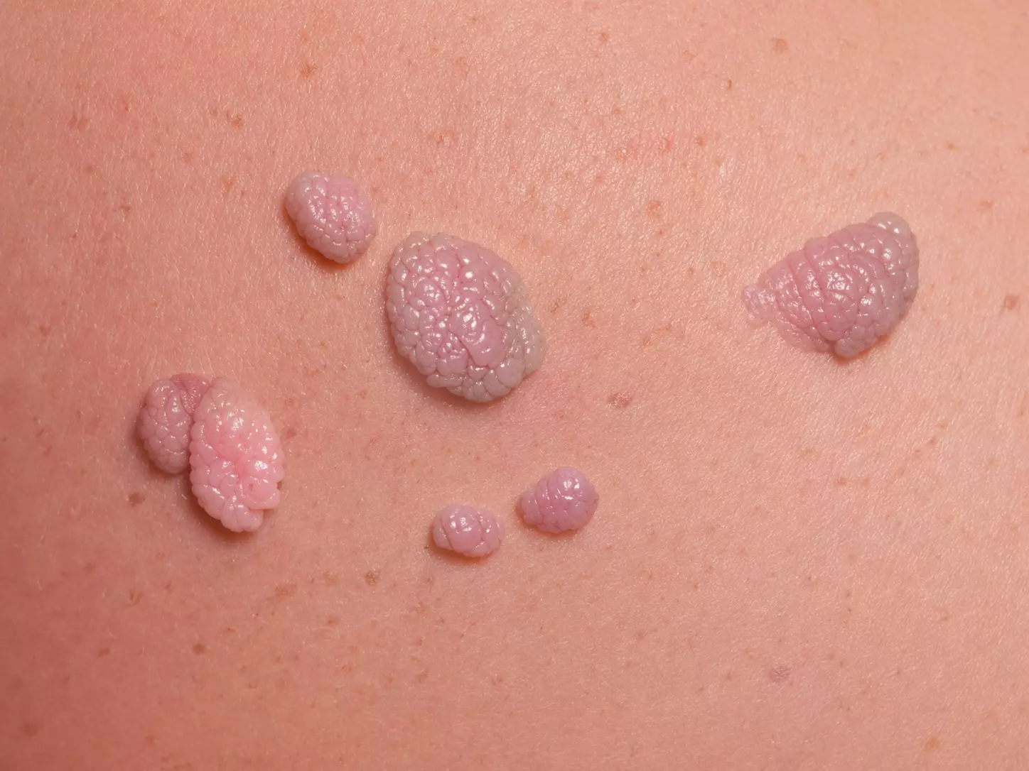 Tratamiento de verrugas genitales con la Dra. Sofía Torres especialista en patología vulvar y tracto genital inferior en Córdoba Capital.